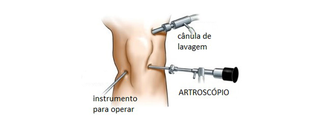 Artroscopia (Geral)